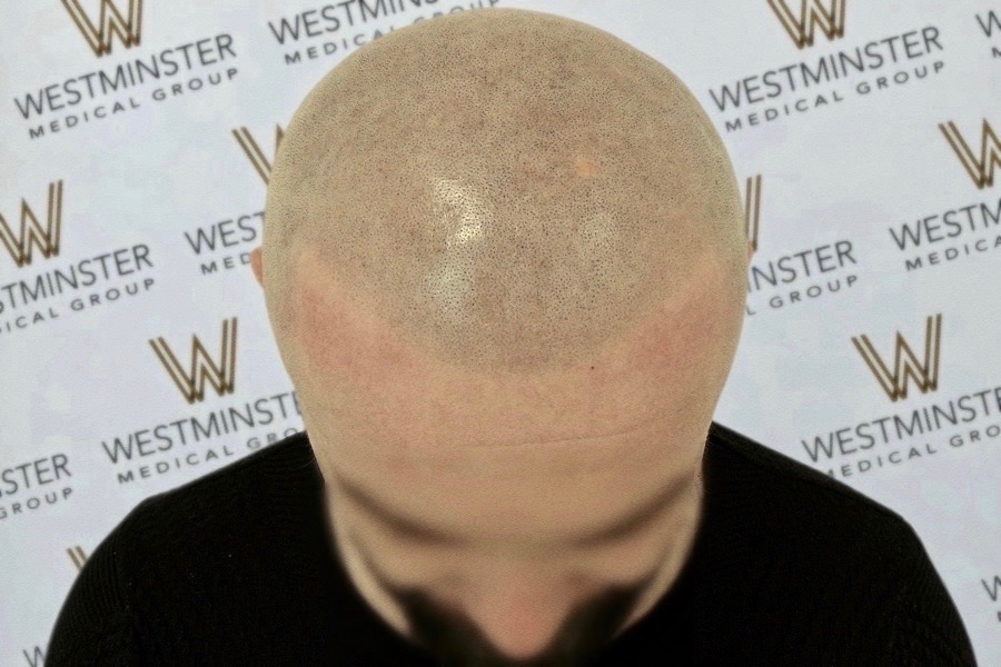 Scalp-Micro-Pigmentation-Result-52.jpeg