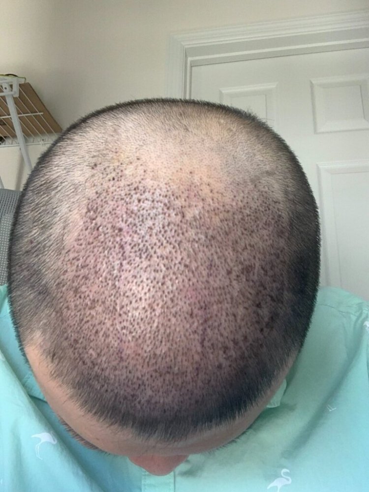 shapiro medical group hair transplant 5 days post-op1.jpg