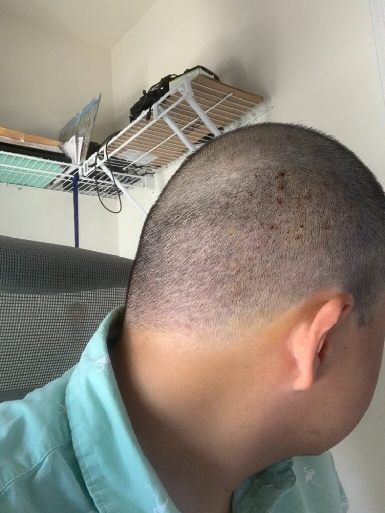 shapiro medical group hair transplant 5 days post-op2.jpg
