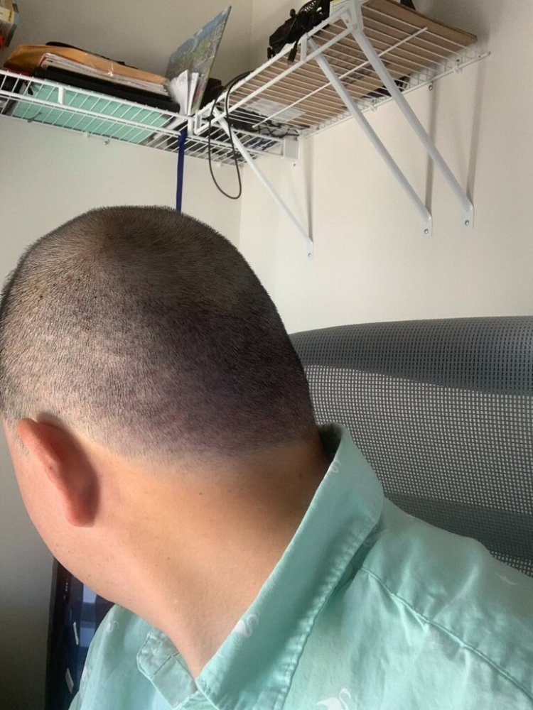 shapiro medical group hair transplant 5 days post-op3.jpg