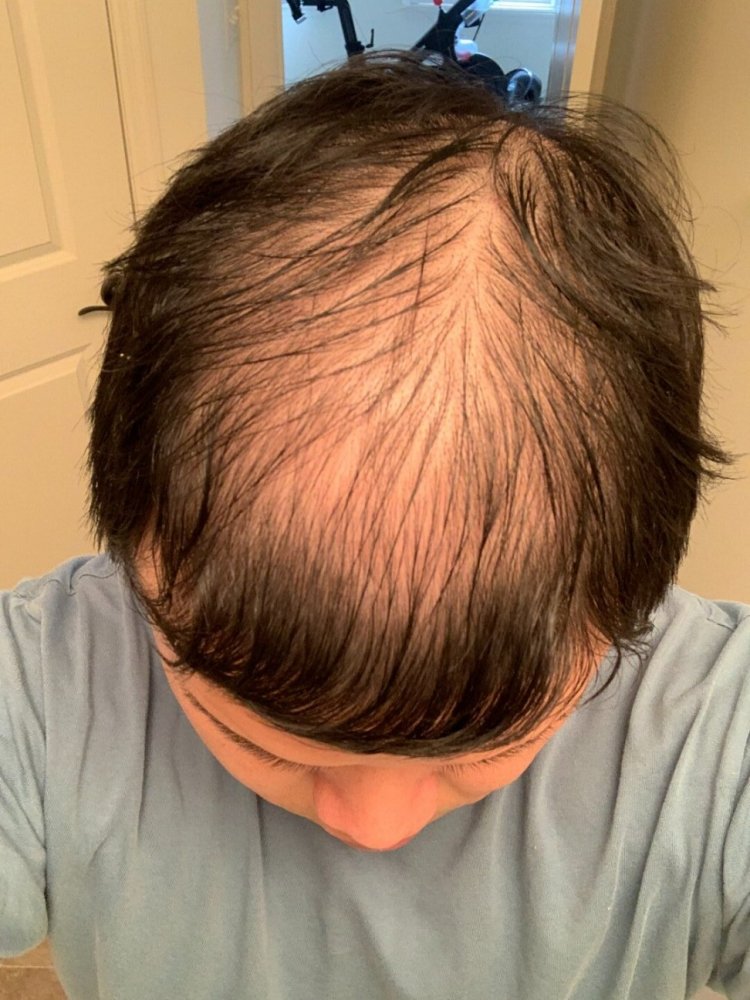 shapiro medical group hair transplant before1.jpeg