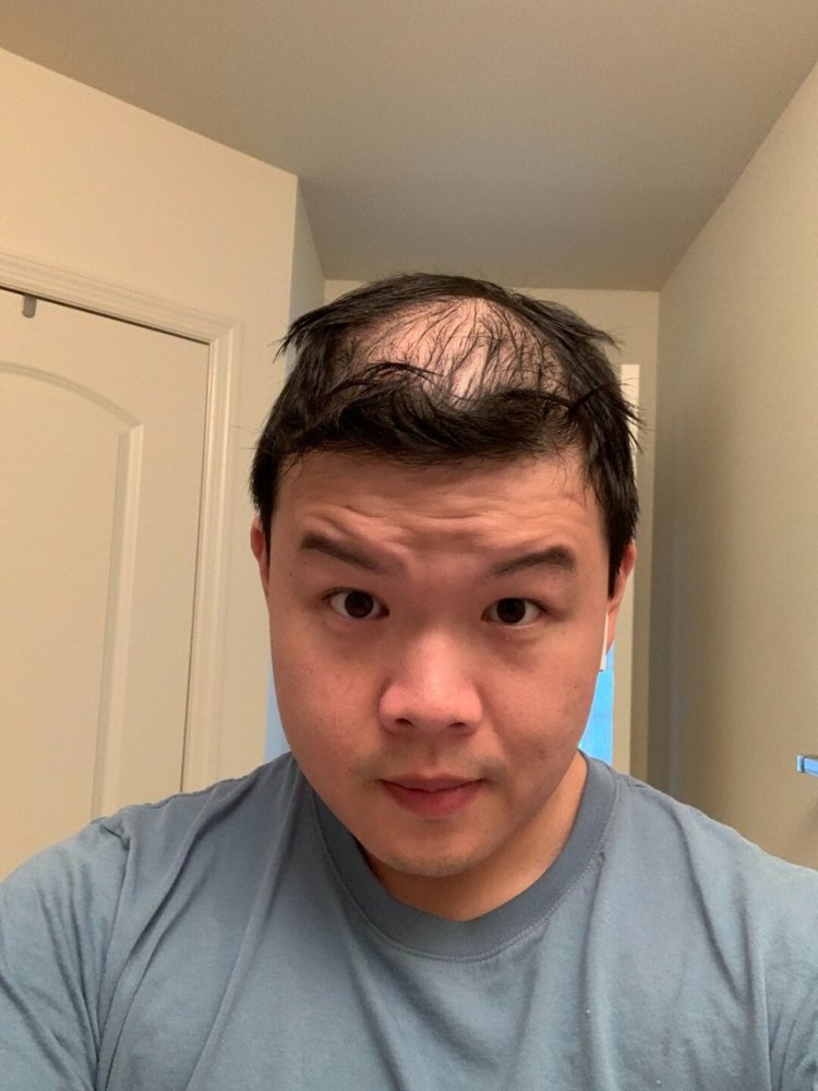 shapiro medical group hair transplant before2.jpeg