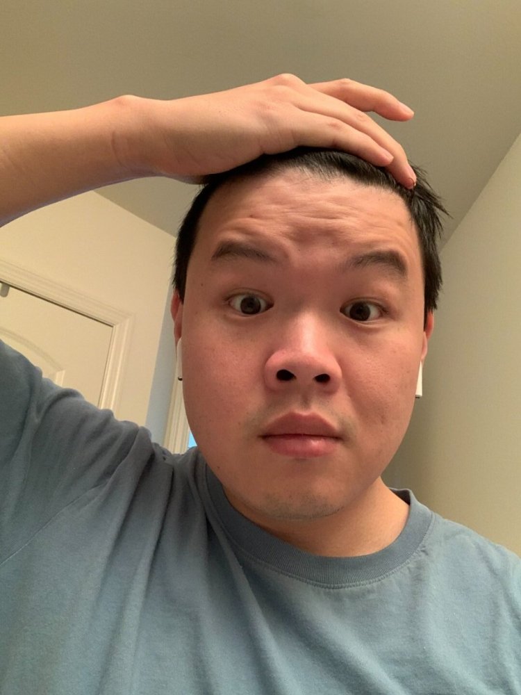 shapiro medical group hair transplant before3.jpeg