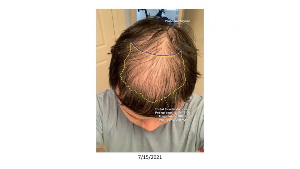shapiro medical group hair transplant before4.jpg