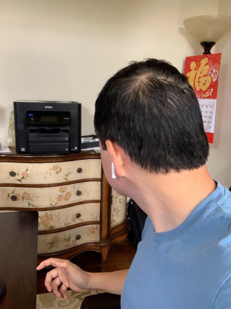 shapiro medical group hair transplant before5.jpeg