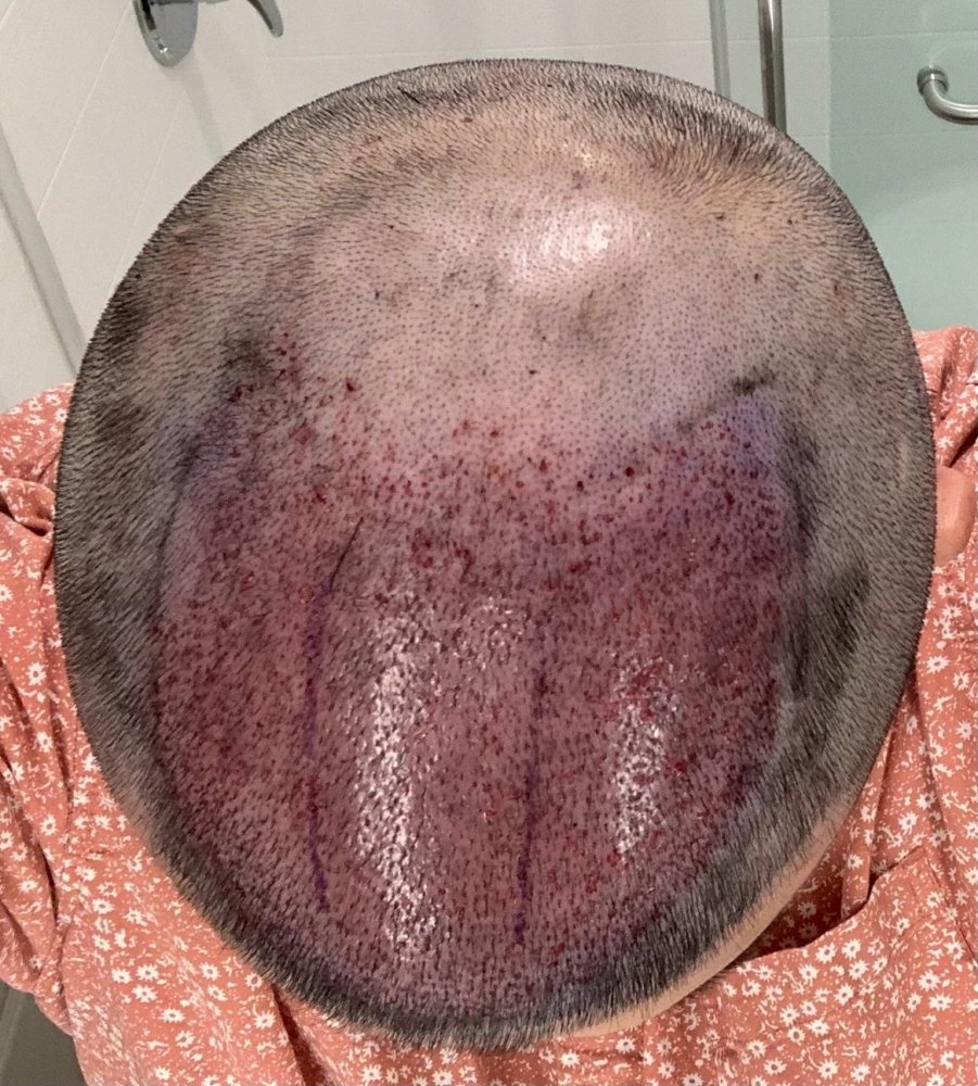 shapiro medical group hair transplant immediate post-op1.jpg