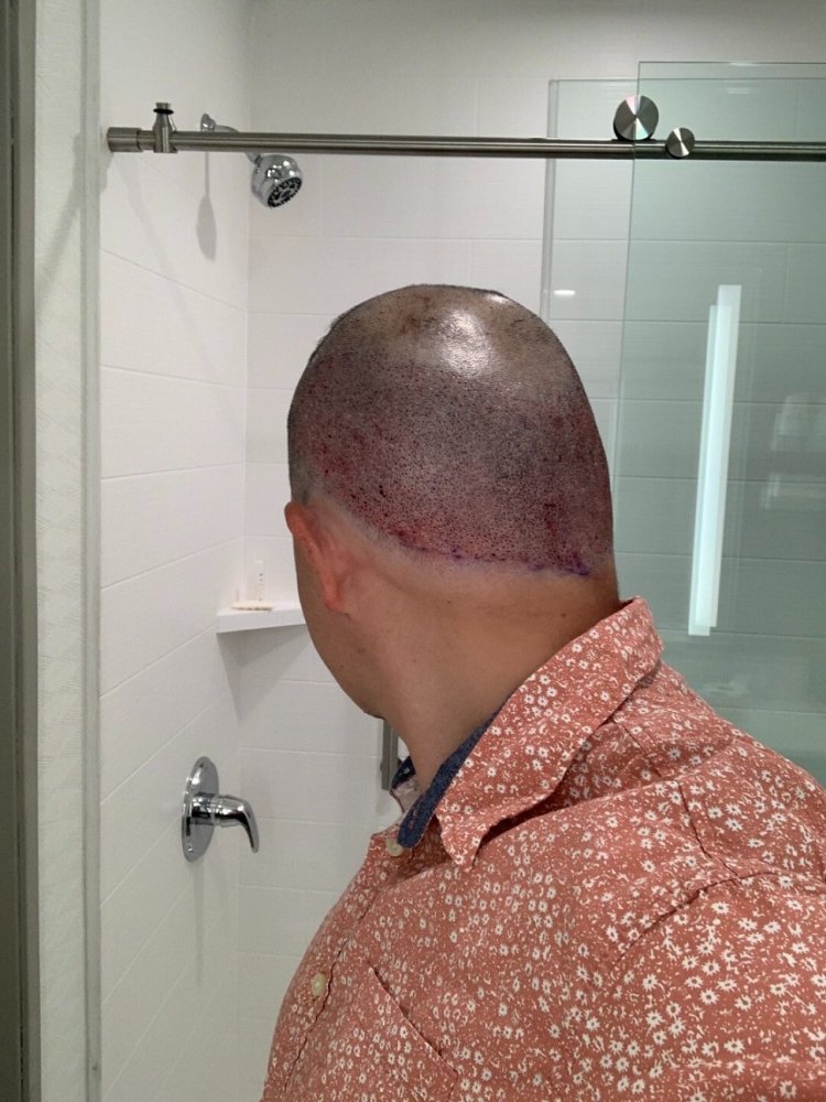 shapiro medical group hair transplant immediate post-op2.jpg