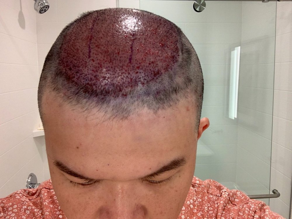 shapiro medical group hair transplant immediate post-op3.jpg
