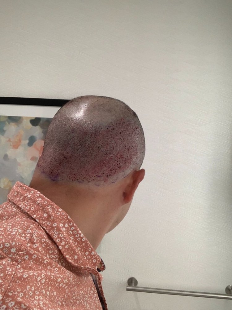 shapiro medical group hair transplant immediate post-op4.jpg
