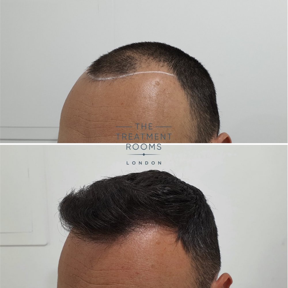 Temple FUE hair transplant before and after 1498 grafts.jpg