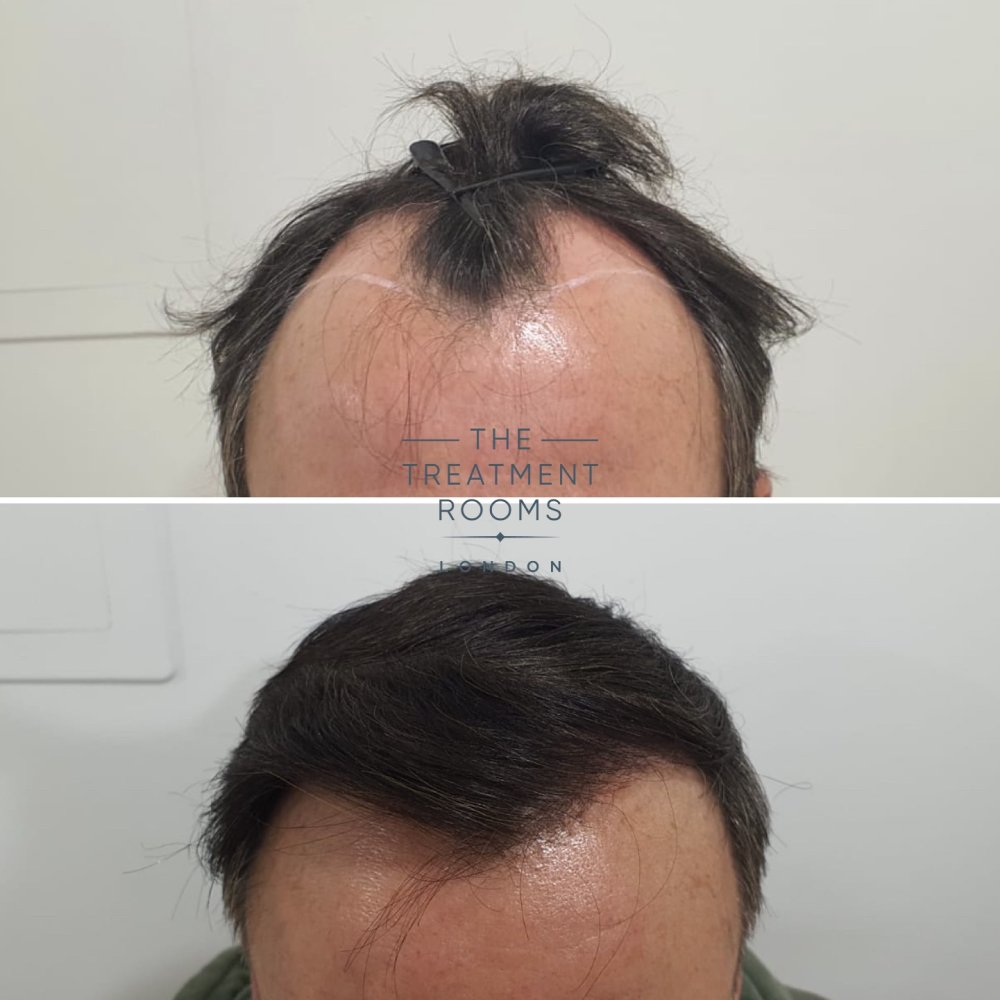 Temple FUE hair transplant London.jpg