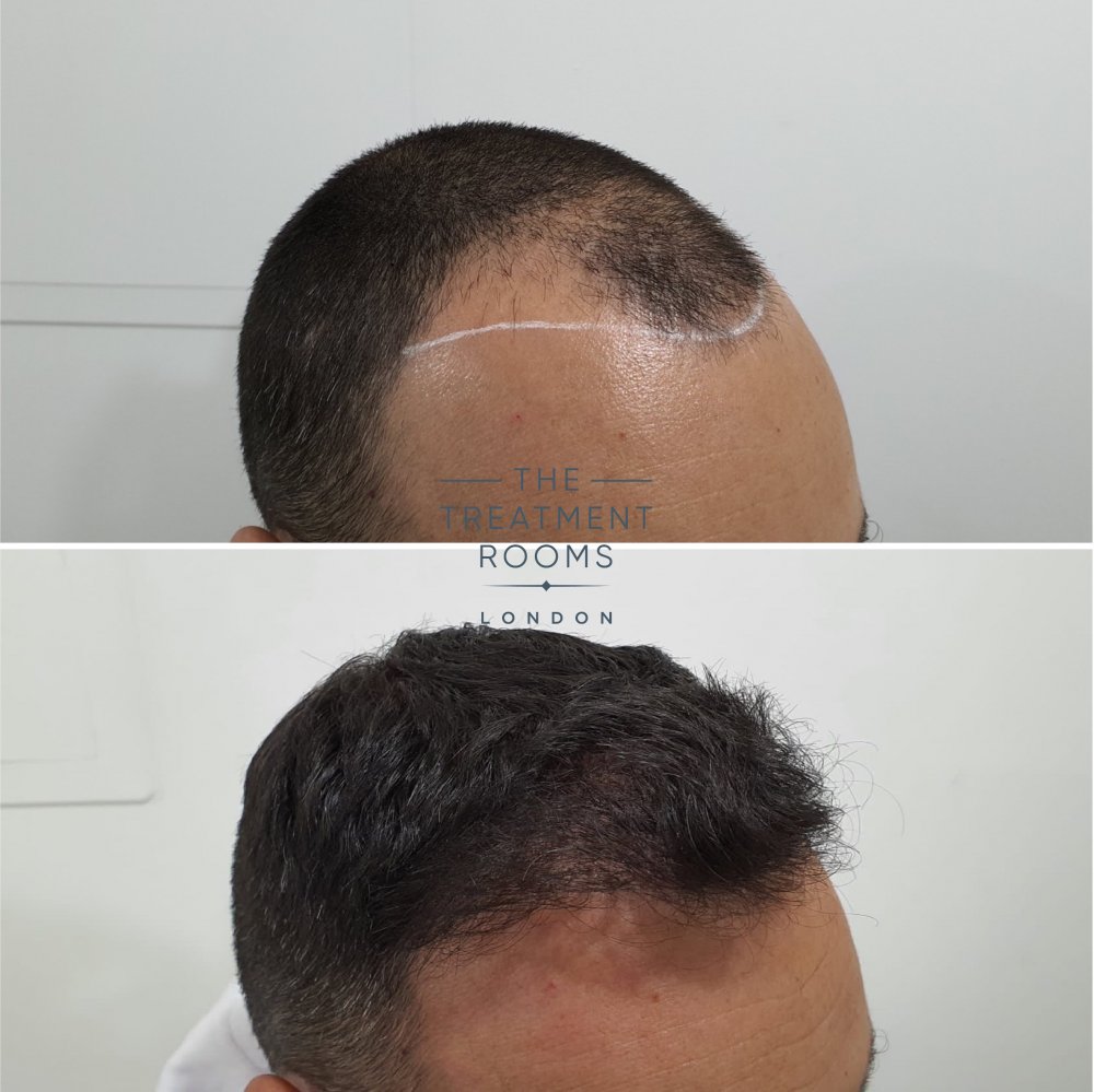 Temple FUE hair transplant result 1498 grafts.jpg