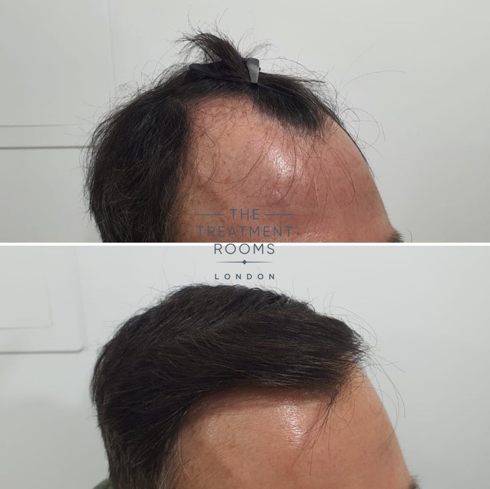 Temple FUE hair transplant result 1800 grafts.jpg