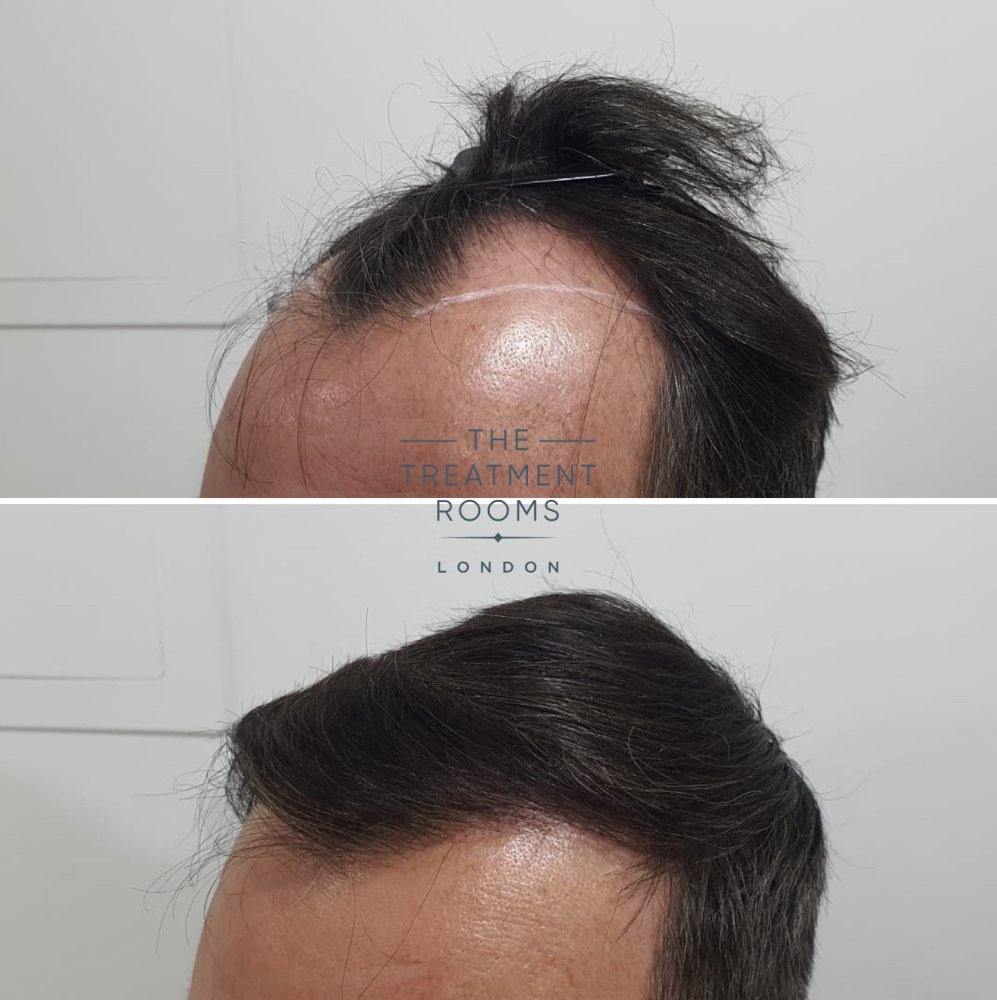 Temple hair transplant before and after 1800 grafts.jpg