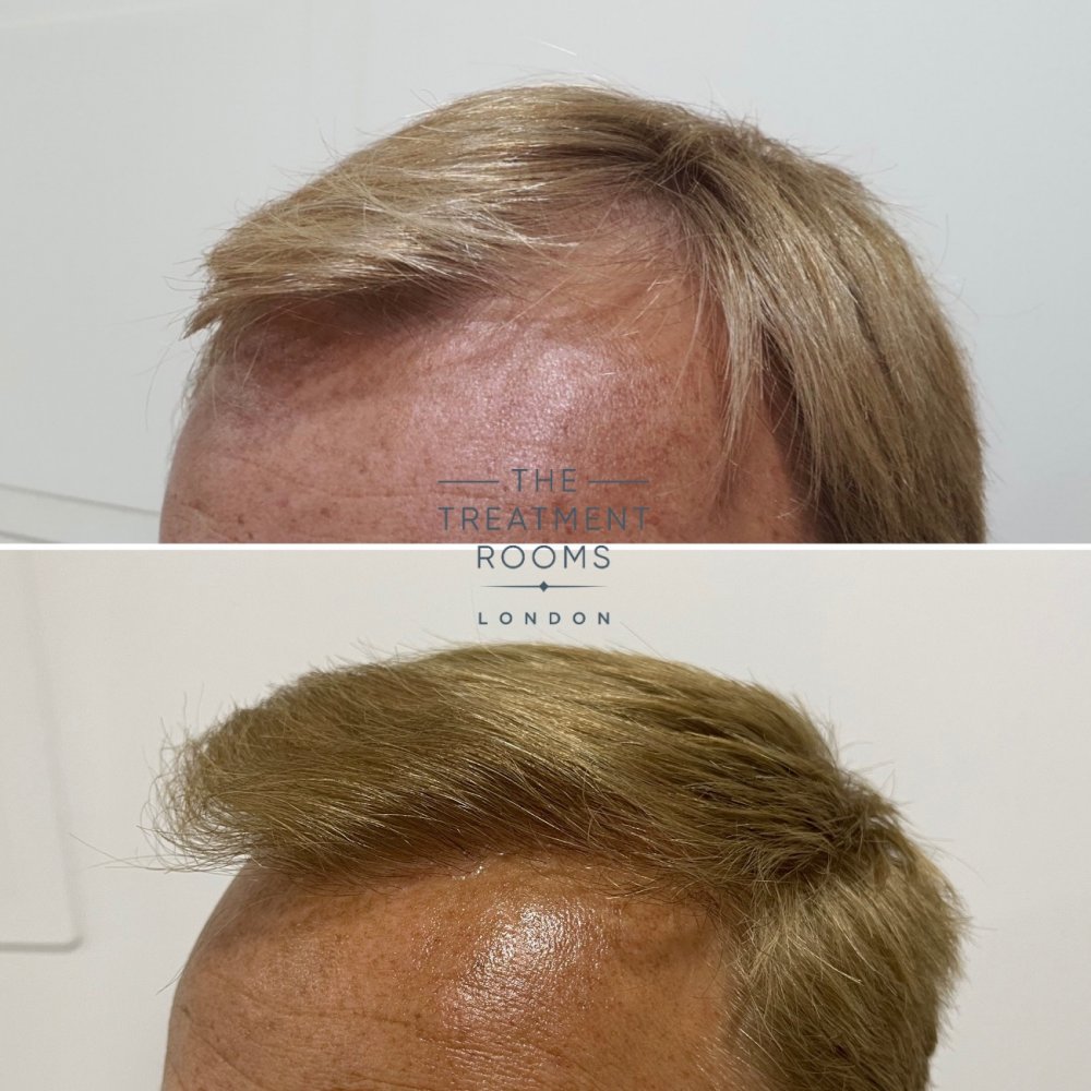 Temple hair transplant before and after.jpg