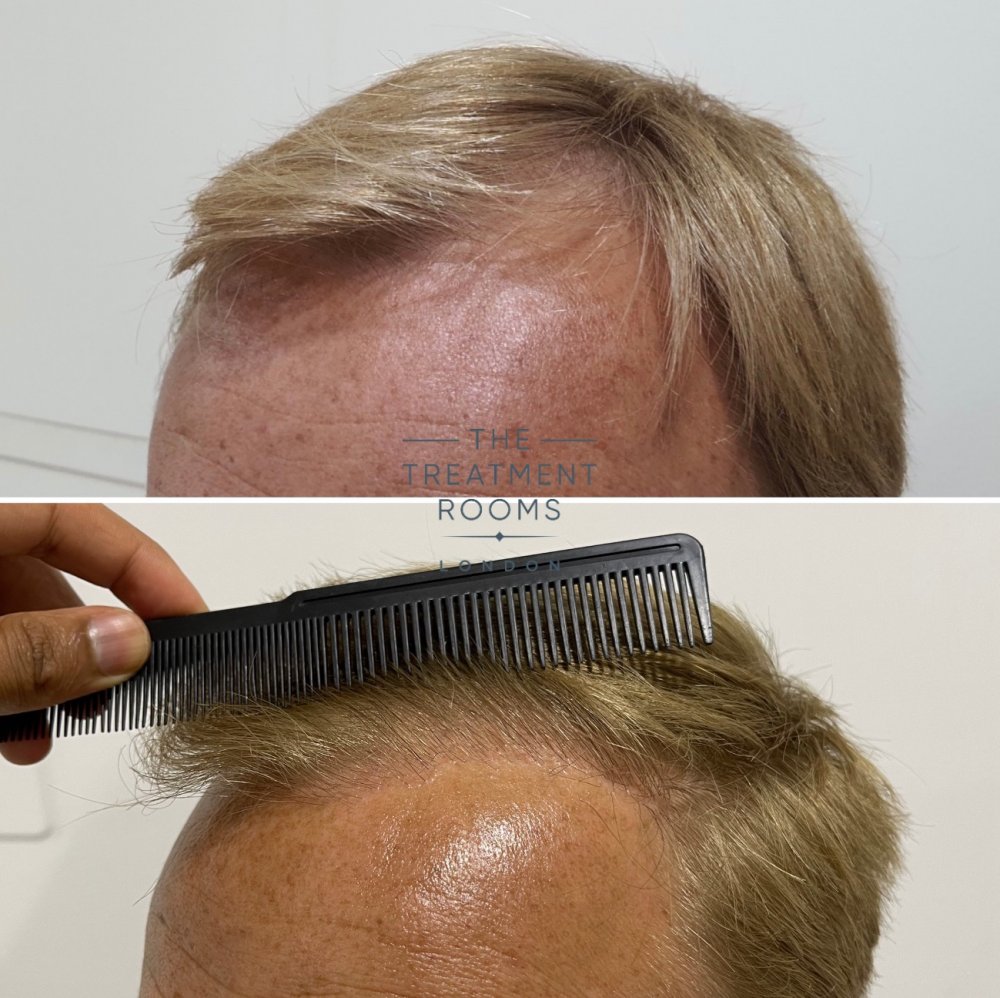 Temple hair transplant before and after with comb.jpg