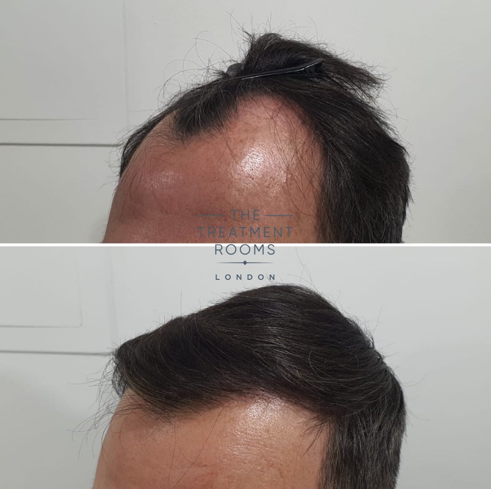 Temple hair transplant result 1800 grafts.jpg