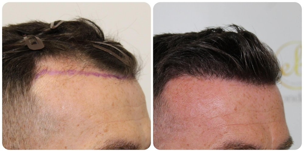 temples-reconstruction-hair-transplant.jpg