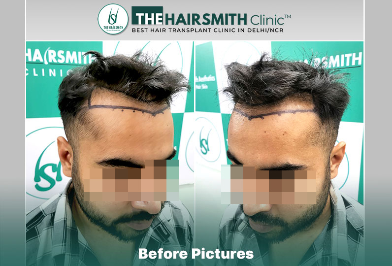 the hairsmith clinic - best hair transplant doctor in india.jpg