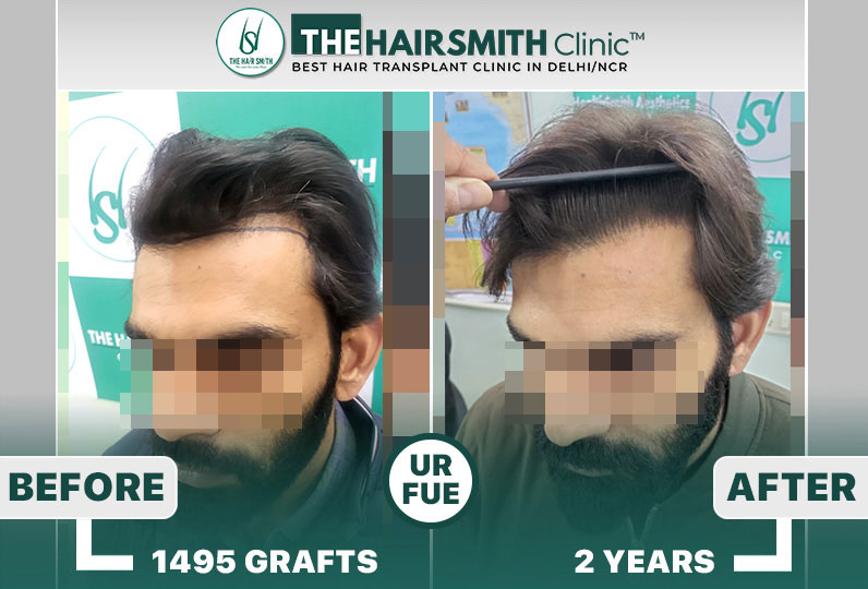 The Hairsmith Clinic - Best Hairline Hair Transplant Result  #HairTransplant #HairsmithHairTra...jpg