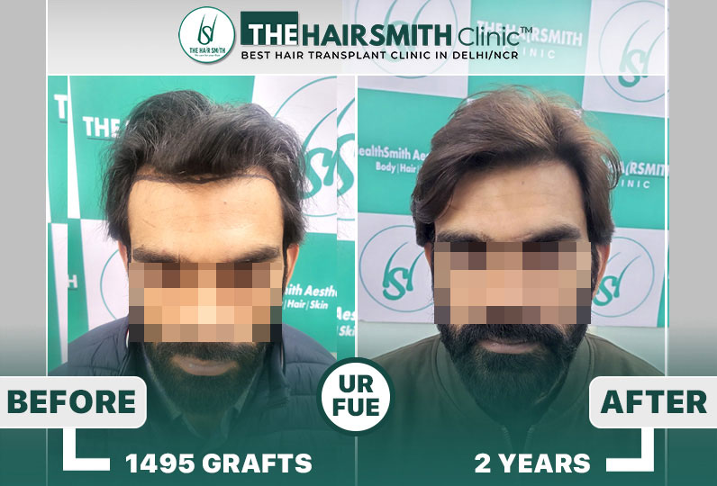 The Hairsmith Clinic - Best Hairline Hair Transplant Result  #HairTransplant.jpg