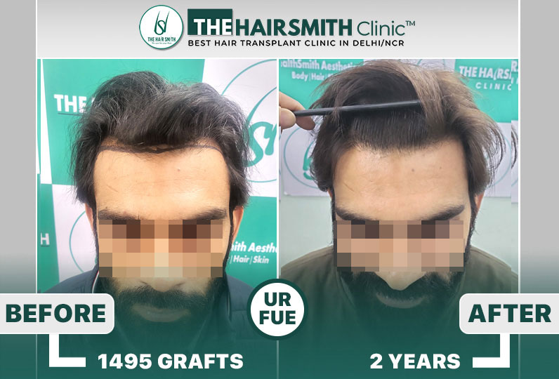 The Hairsmith Clinic - Best Hairline Hair Transplant Result  #HairTransplant #TheHairsmithClinic.jpg