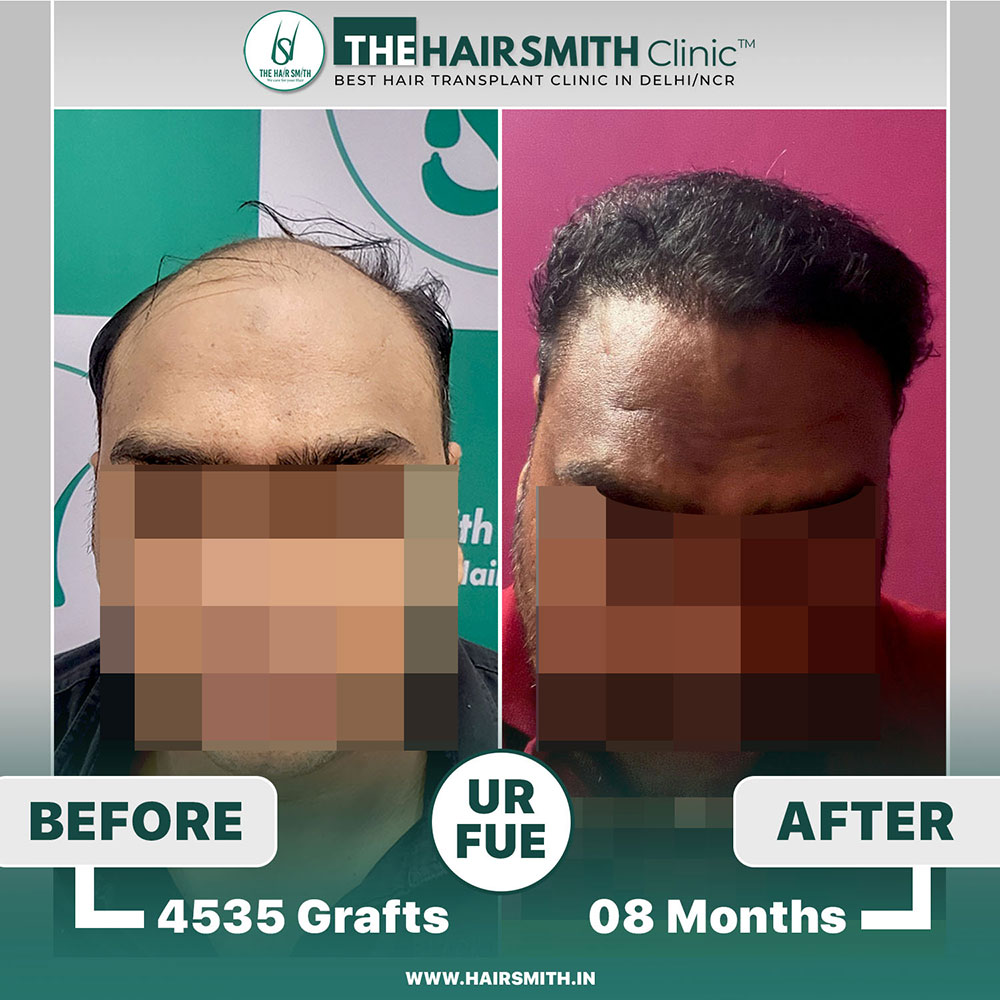The Hairsmith Clinic Hair Transplant Result - Before and after result 1.jpg