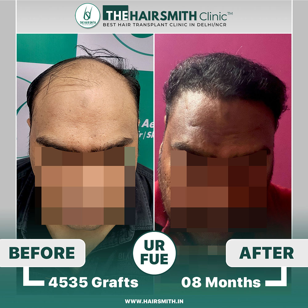 The Hairsmith Clinic Hair Transplant Result - Before and after result 2.jpg