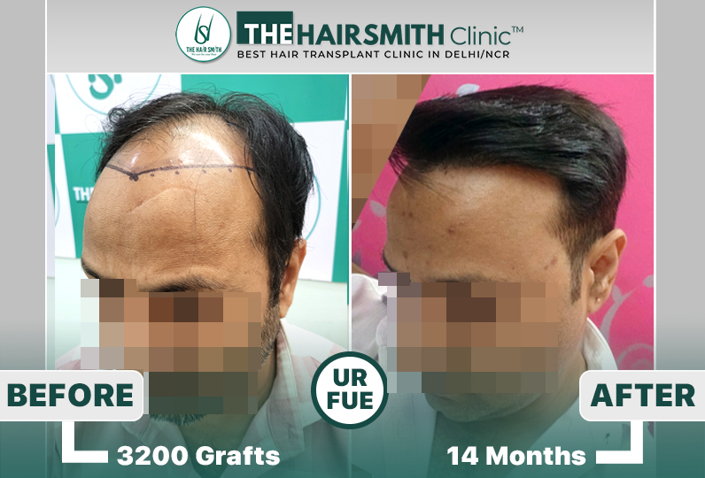 the hairsmith clinic hair transplant result #hairtransplant #hairsmithhairtransplant #hairregr...jpg