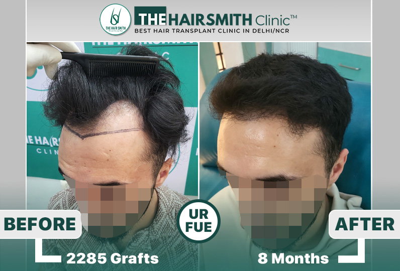 the hairsmith clinic hair transplant result #hairtransplant #hairsmithhairtransplant #hairregr...jpg
