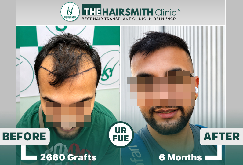 the hairsmith clinic hair transplant result #hairtransplant #hairsmithhairtransplant.jpg