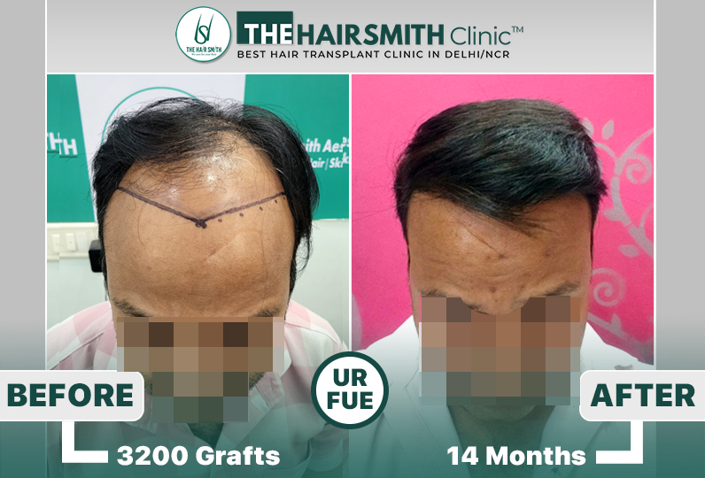 the hairsmith clinic hair transplant result #hairtransplant #hairsmithhairtransplant.jpg