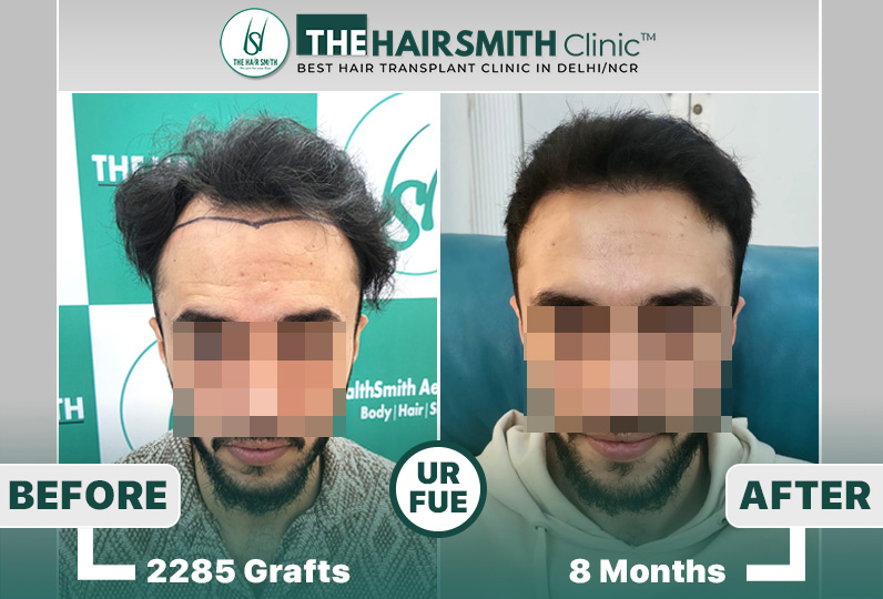 the hairsmith clinic hair transplant result #hairtransplant #hairsmithhairtransplant.jpg