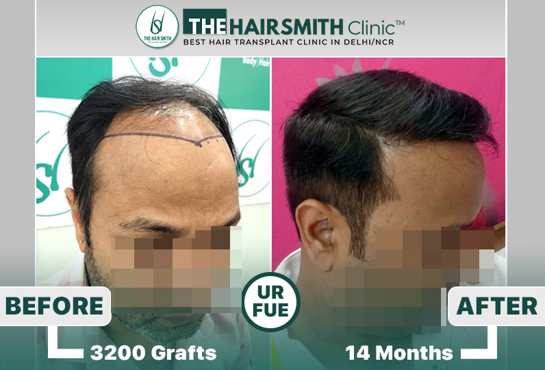 the hairsmith clinic hair transplant result #hairtransplant #hairsmithhairtransplantcost.jpg