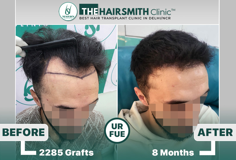 the hairsmith clinic hair transplant result #hairtransplant #hairsmithhairtransplantcost.jpg