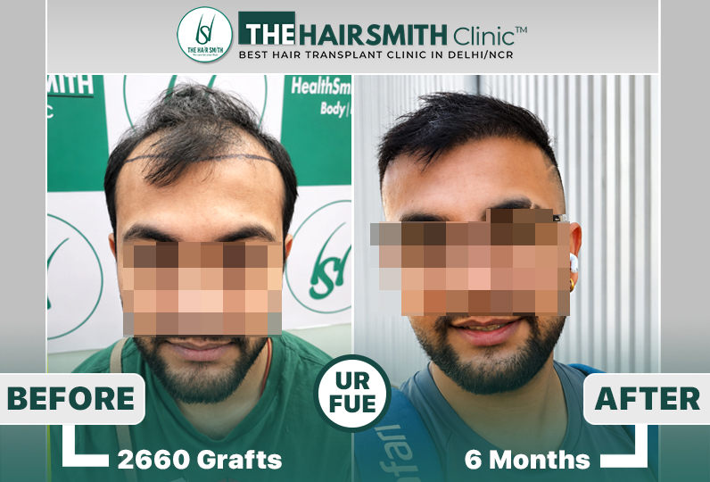 the hairsmith clinic hair transplant result #hairtransplant.JPG