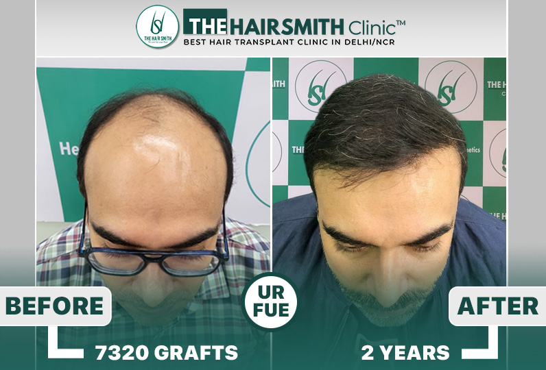 The Hairsmith Clinic Hair Transplant Results #BestHairTransplantResults #HairTransplantResult.jpg