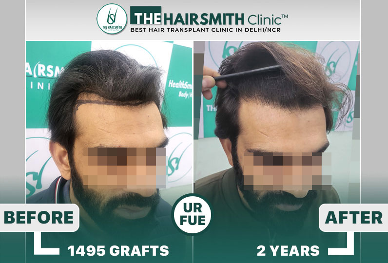 The Hairsmith Clinic - Hairline Hair Transplant Result  #HairTransplant #HairsmithTransplantRe...jpg