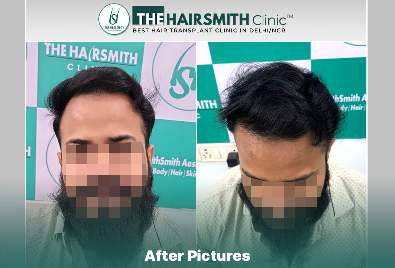 the hairsmith clinic result - 11 months update - 1.jpg