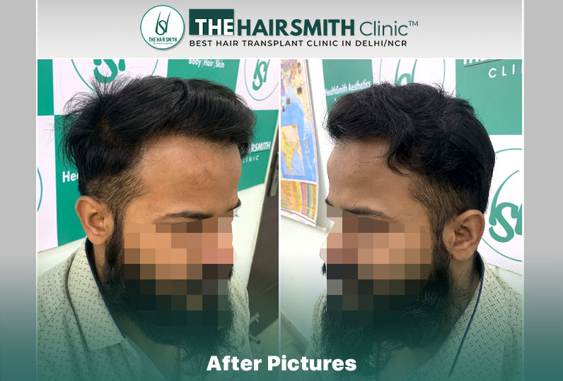 the hairsmith clinic result - 11 months update - 2.jpg