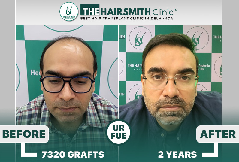 The Hairsmith Hair Transplant Results #HairTransplant #HairTransplantResult.jpg