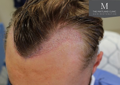 The-Maitland-Clinic-Dr-Ball-FUE-Immediate-Post-Op-2.jpg