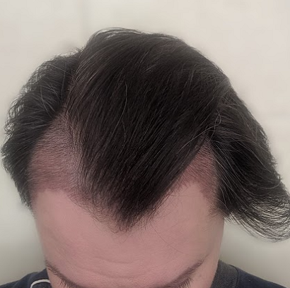 The Maitland Clinic - Hair Transplant.png