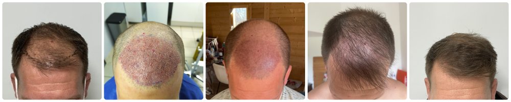 timeline 2000 grafts dr bonaros.jpg