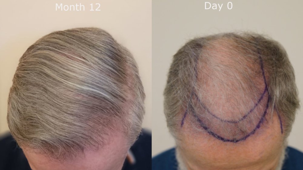 top month 12 v Day 0.jpg