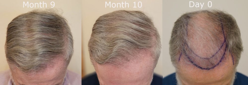 top month 9 v month 10 v Day 0.jpg