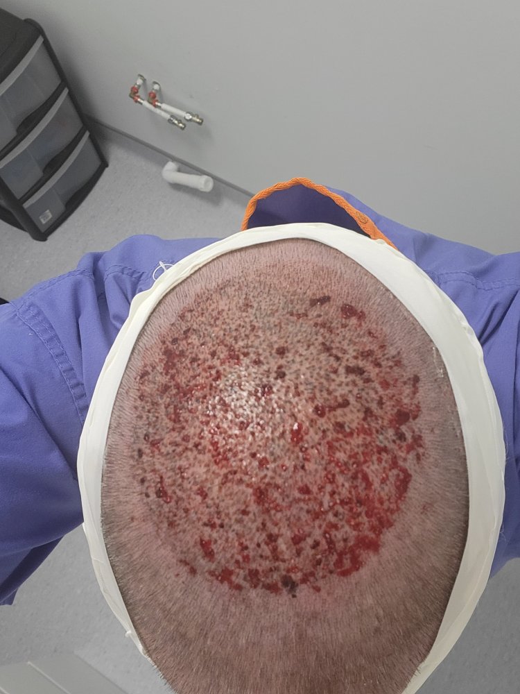 Transplant.jpg