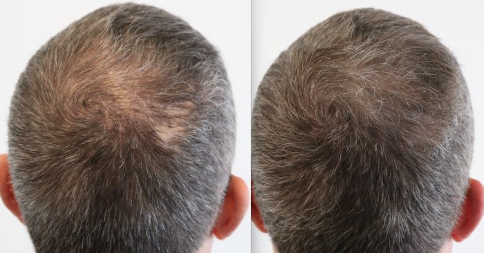 voor en na haarverdichting met micro haar pigmentatie prohairclinic.jpg