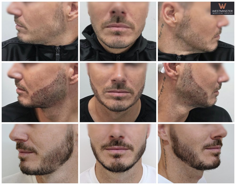 WMG Beard FUE.jpg