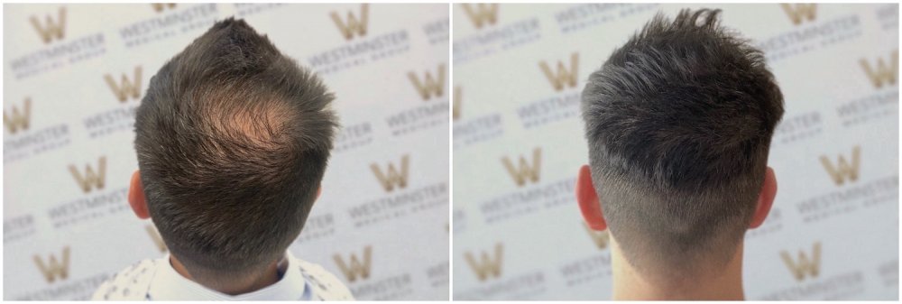 WMG Crown Hair Transplant London.jpg